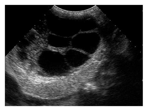 Ultrasonography Scan Of Liver Showing Multilocular Anechoic Cystic