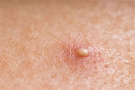 9 home remedies for staph infection you didn t know about