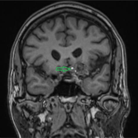 Brain Cavernoma Axial Mri T2 Weighted Image Shows Central High Signal