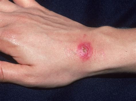 A 43 Year Old Woman With A New Ulcer On One Hand Journal Of Urgent