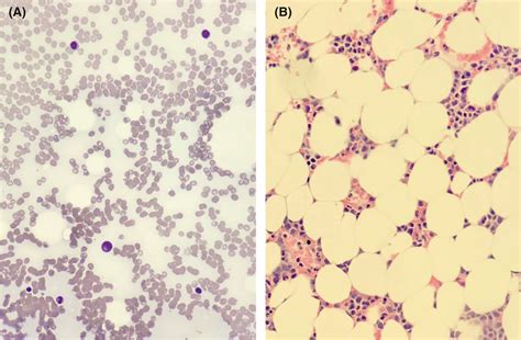 Very Severe Aplastic Anemia In An 80‐year‐old Man Kasinathan 2021