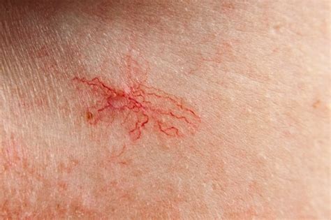 Spider Nevus Patofisiologi Diagnosis Penatalaksanaan Alomedika