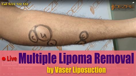 Lipoma Removal Treatments In Hindi Multiple Lipoma Removal Surgery In