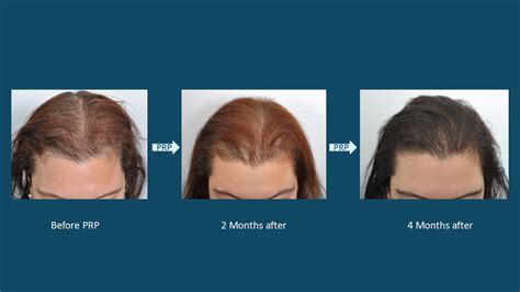 Hair Loss Treatments Non Surgical For Women Dr David Rosenberg