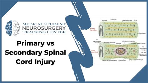 Primary Vs Secondary Spinal Cord Injury Youtube