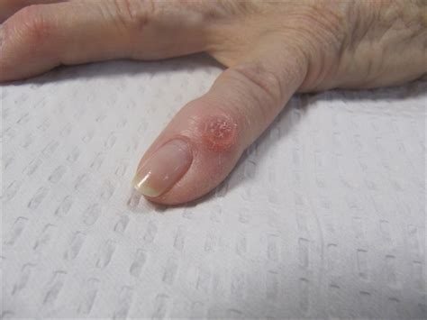 A Blister Like Lesion On The Finger Clinical Advisor