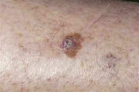 Precancerous Skin Lesion Stock Image M2100438 Science Photo Library