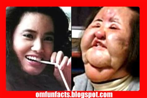 Top 10 Worst Plastic Surgery Disasters Celebrity1st