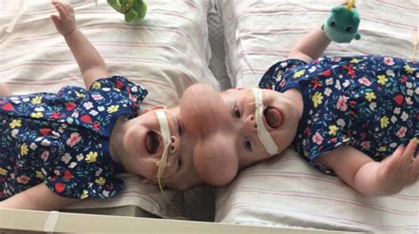 Conjoined Twins With Rare Condition Separated In 11 Hour Long Surgery Conjoined Twins With