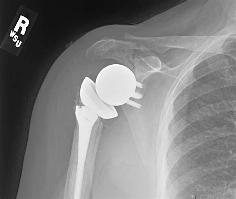 Uw Shoulder And Elbow Academy Acromial Fractures After Reverse Total