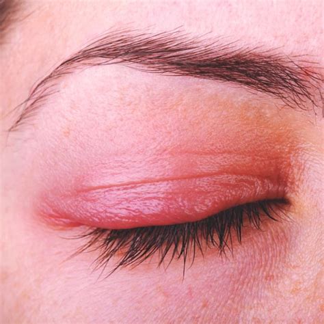 Whats Causing My Funky Eyelid Eye Irritation Remedies Dry Eye