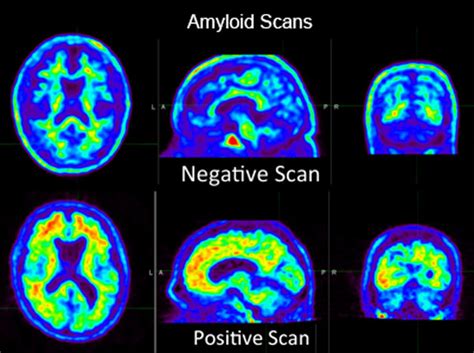 Radiologys Role In Determining The Impact Of Amyloid Pet Imaging On