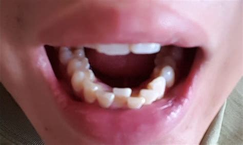 Try to break any habits that put outward pressure on the teeth. Possible to fix front crooked teeths without braces - www ...