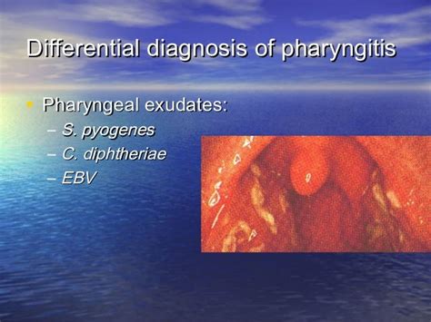 Pharyngitis