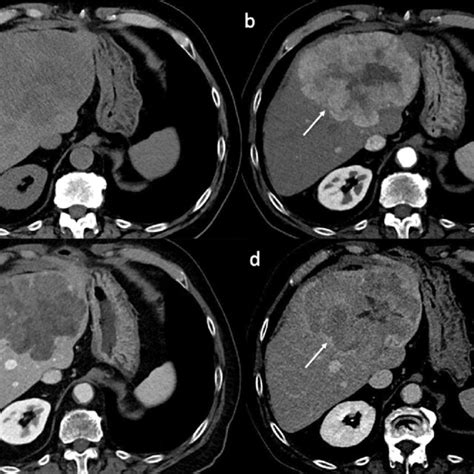 Lymph Node Recurrence Axial Contrast Enhanced Ct Images On The Portal