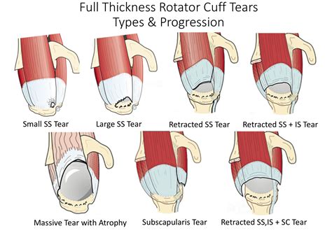 Rotator Cuff Disease Cambridge Shoulder