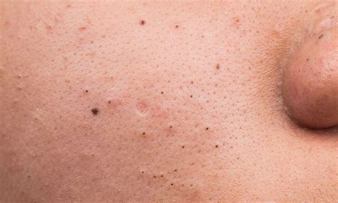All About Blackheads Best Acne Treatments And Product Reviews For Your Skin