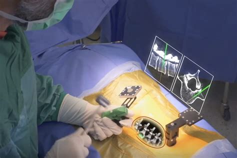 The 1st Augmented Reality Spine Surgeries Are Carried Out By Israeli