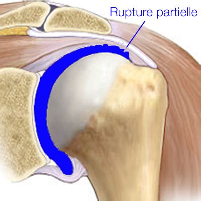 J'ai rv avec le chir mardi pour savoir ce que l'on peut faire pour la dernière épaule, la droite, a été opérée il y a 2 ans, mais maintenant depuis quelques mois, je. Site de l'épaule, Les fractures de et autour de l'épaule ...