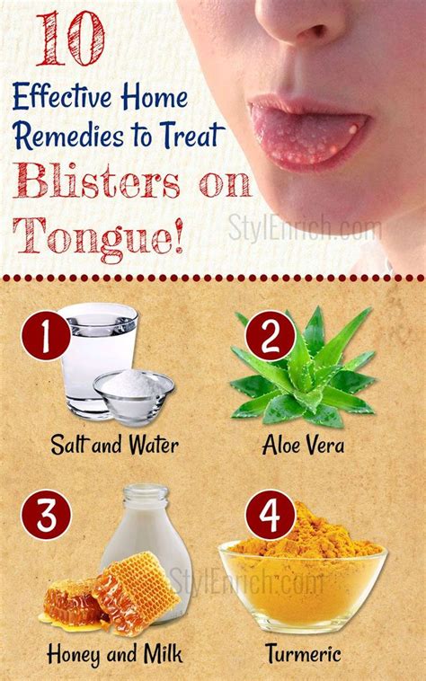 Home Remedies For Blisters On Tongue How To Treat Tongue Blisters