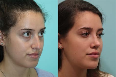 Rhinoplasty Photos Chevy Chase Md Patient 22936