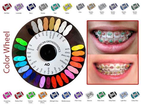 Beautiful Braces Colors Orthodontics Braces Braces Colors Braces Color Wheel Braces Colors