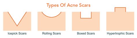 Types Of Acne Scars And How To Treat Them Dr Dennis Gross