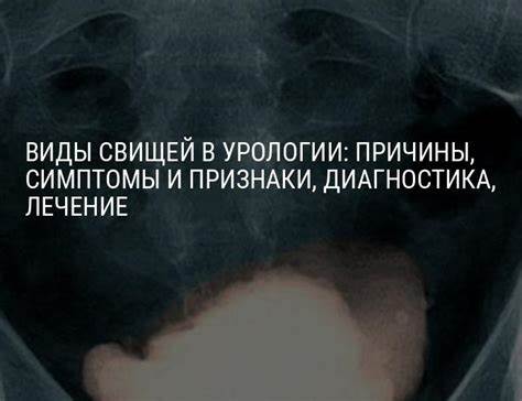 Кишечный свищ диета Свищ пузырно-кишечный, пузырно-маточный, уретральный, утретро Свищ пузырно-кишечный, пузырно-маточный, уретральный, утретро Кишечный свищ диета