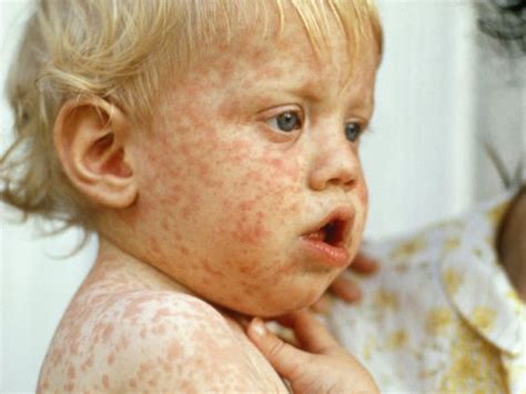 Visual Guide To Childrens Rashes And Skin Conditions Baby Rash On