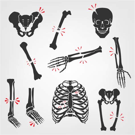 Broken Bone Illustrations Royalty Free Vector Graphics