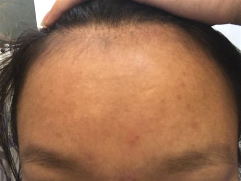 Small Bumps On Forehead General Acne Discussion Acne Org Forum