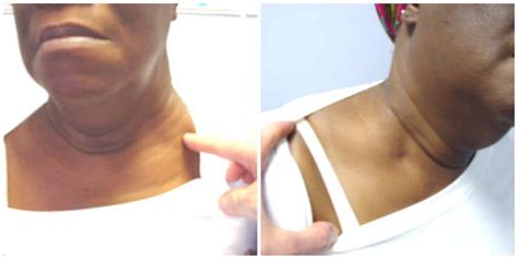 Swelling Near Neck Shoulder