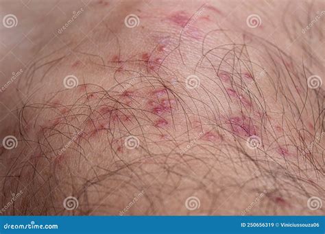 Allergic Reactions To Tick Bites Stock Image Image Of Hardbacked