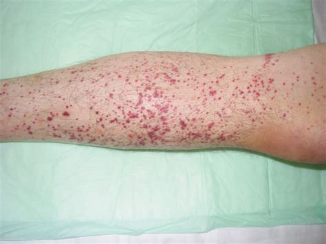 Vasculitis Skin Rash