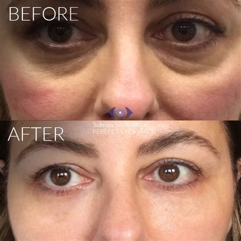 Tear Trough Fillers A Solution To Dark Circles Eye Bags