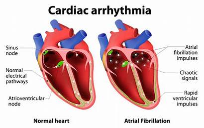 Cardiac Arrhythmia Aid