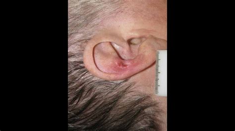 Auricular Anthelix Basal Cell Carcinoma Youtube