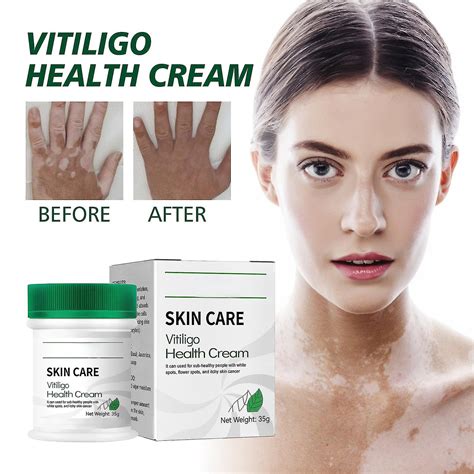 Crema De Vitiligo Tratamiento Del Vitiligo Para La Piel Vitíligo