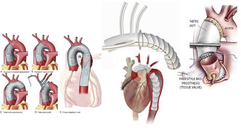 surgery of the aorta aortic root ascending and arch of the aorta descending thoracic aorta