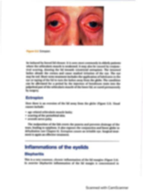 Solution Abnormalities Of Eyelids Studypool