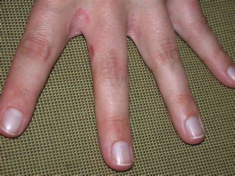 Contact Dermatitis Overview And More