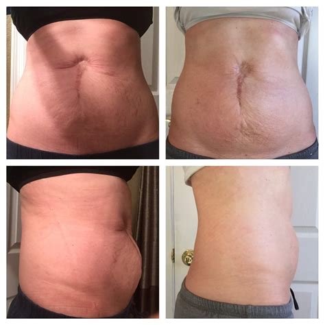 Many women suffer from lingering core issues for years, and even decades, after their pregnancies. Diastasis Recti Surgery Update: 2 years later - it's a ...
