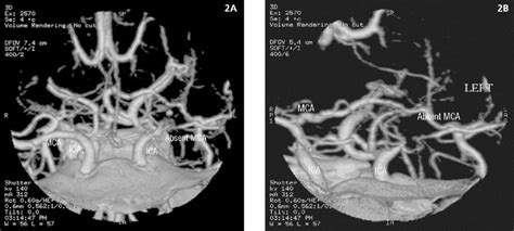 Three Dimensional Reconstruction Of Computed Tomography Ct Angiogram