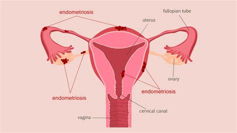 What is Endometriosis Doç Dr Çağlar Helvacıoğlu