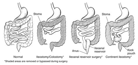 Seeking Healthy Life What Is An Ileostomy Surgery Types Of An Ileostomy