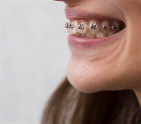 Braces By Specialist Orthodontist Orthodontics Kingston London