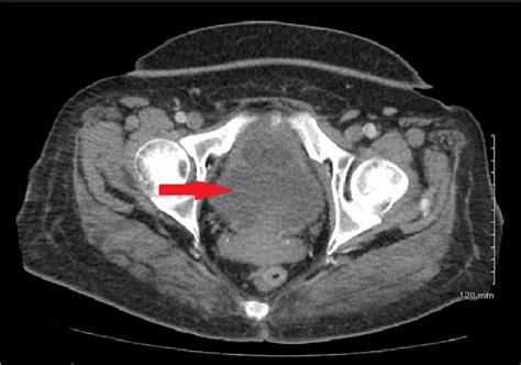 ct scan of pelvis showing uterine hypodense mass download scientific diagram