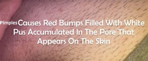 It creates a raised up, red bump(s) that appears or looks like a little pimple. Difference between Herpes (STD) vs Genital grains vs ...