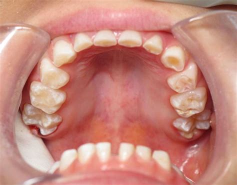 Search only for how to stop gritting your teeth BC Dentist Addresses Teeth Grinding - My Dentist News BC