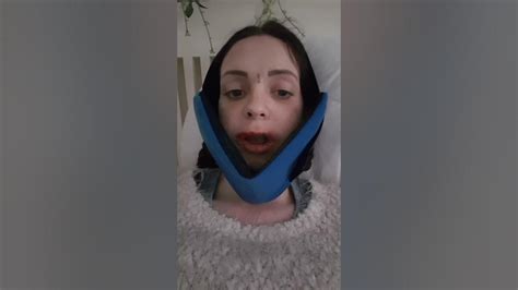 Double Jaw Surgery And Lefort1 For Overbite And Gummy Smile Day 2